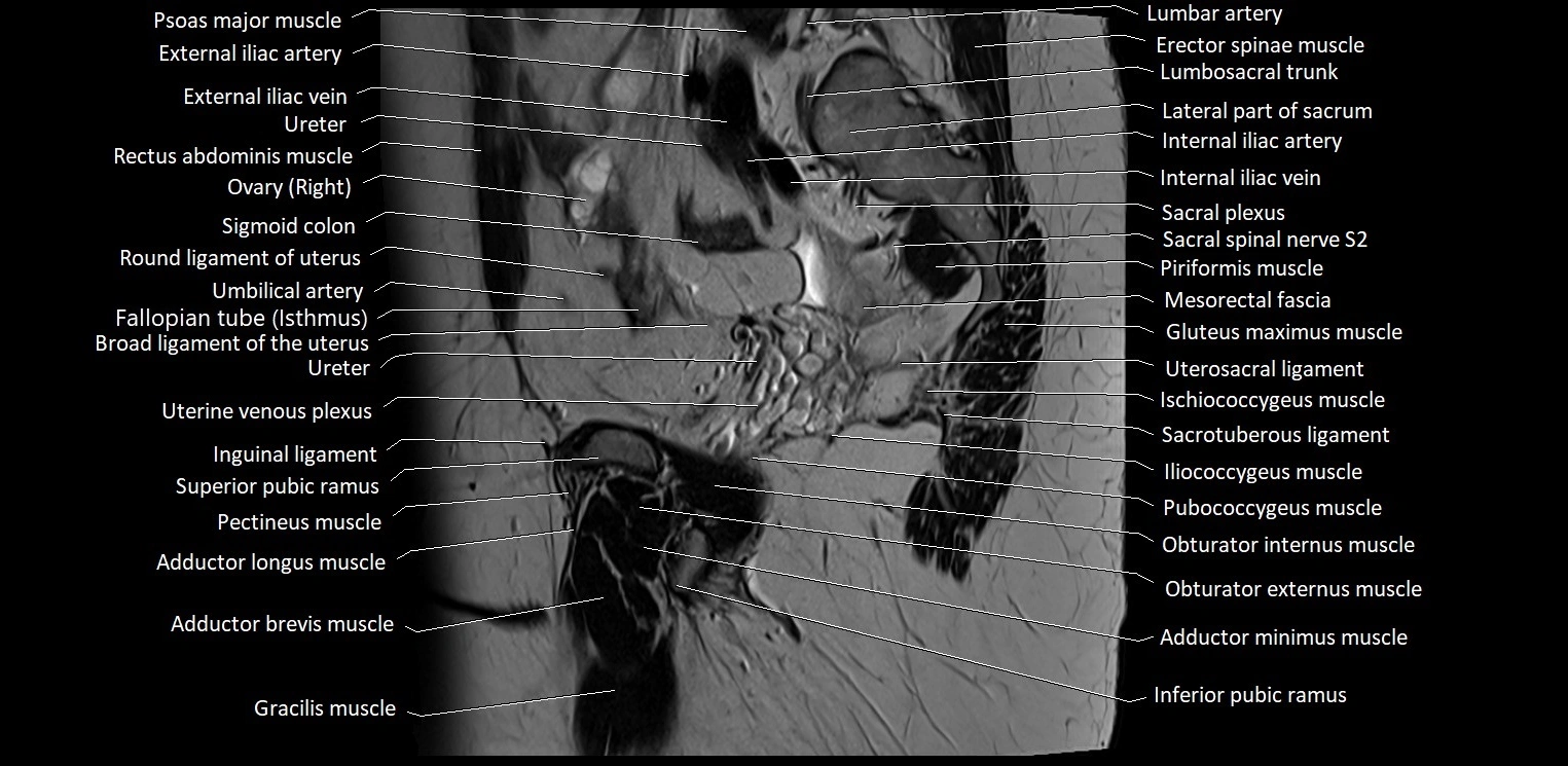 Sagittal cross sectional anatomy of female pelvis (MRI 3T) image 12.webp